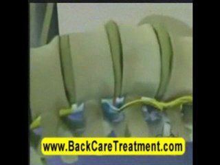 Spinal decompression therapy on CBS news