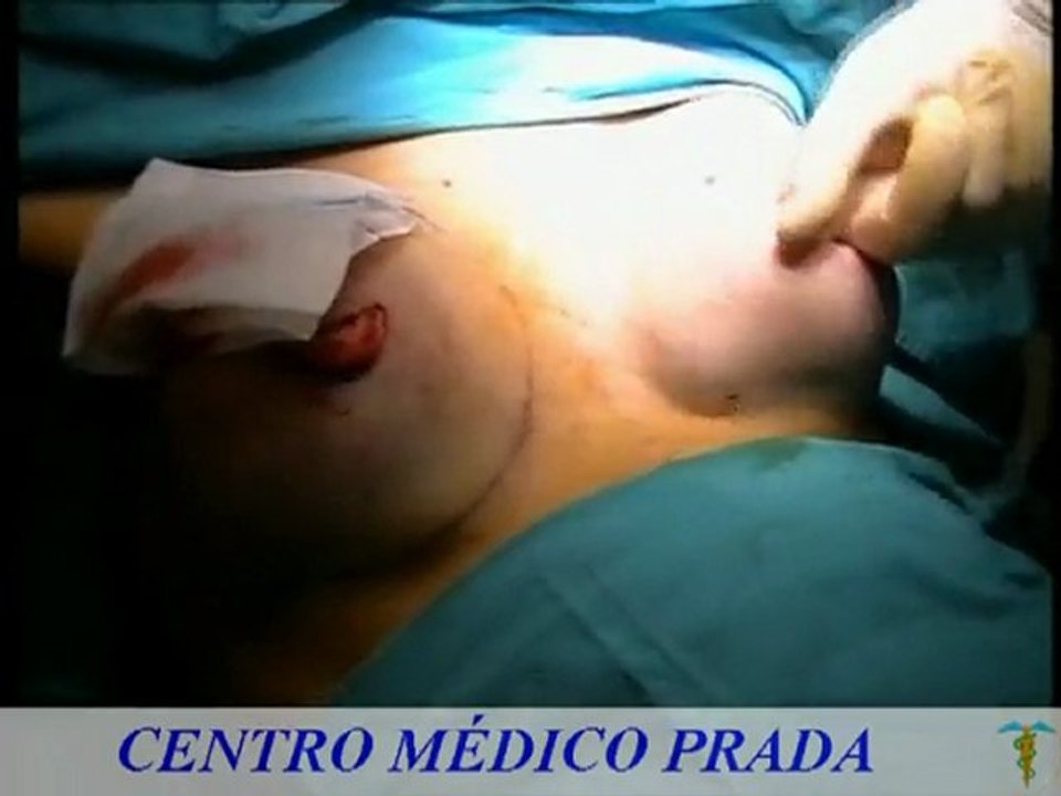 Clinica Prada - Mamoplastia de aumento - Aumento de pecho