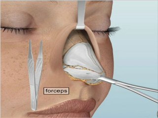 RinoEstetik-aciki-rinoplasti-ameliyati(opened)