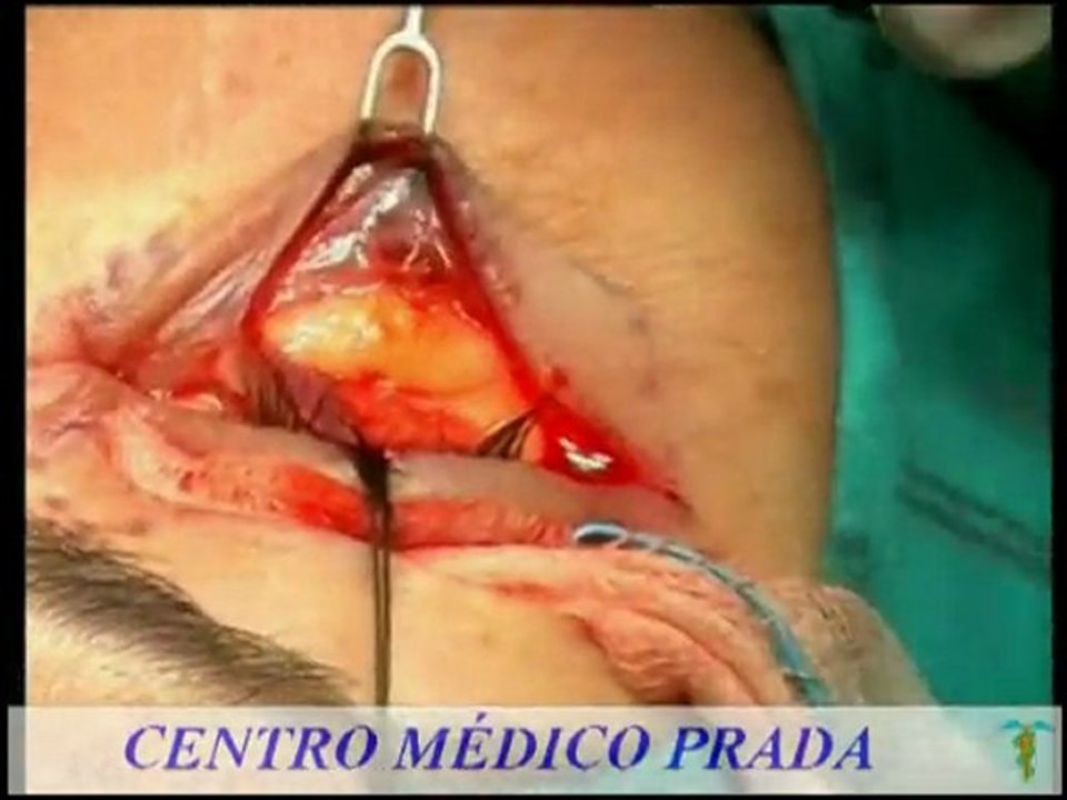 Clinica Prada - Blefaroplastia - Cirugia estetica parpados