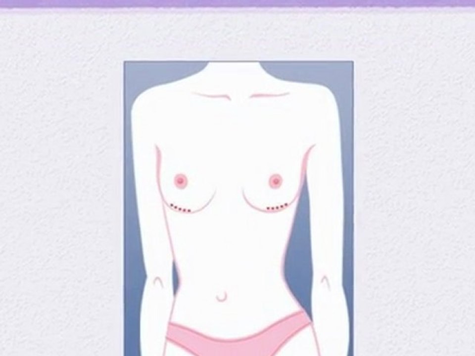 San Francisco Breast Enhancement Surgery-Choosing Incision
