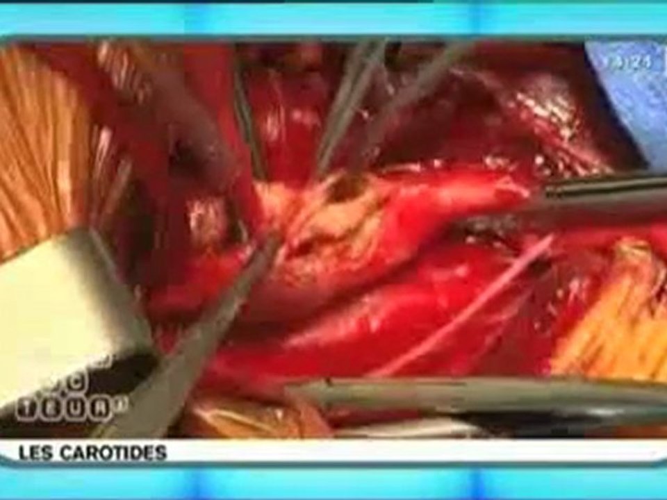 Le Zapping Du Magazine De La Santé De La Semaine -19/03/2010