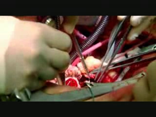 Transplanting Memories 3