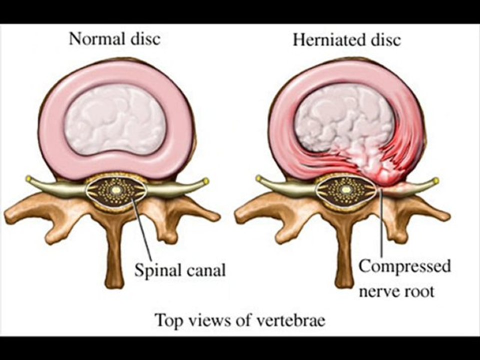 Herniated Disc Surgery.