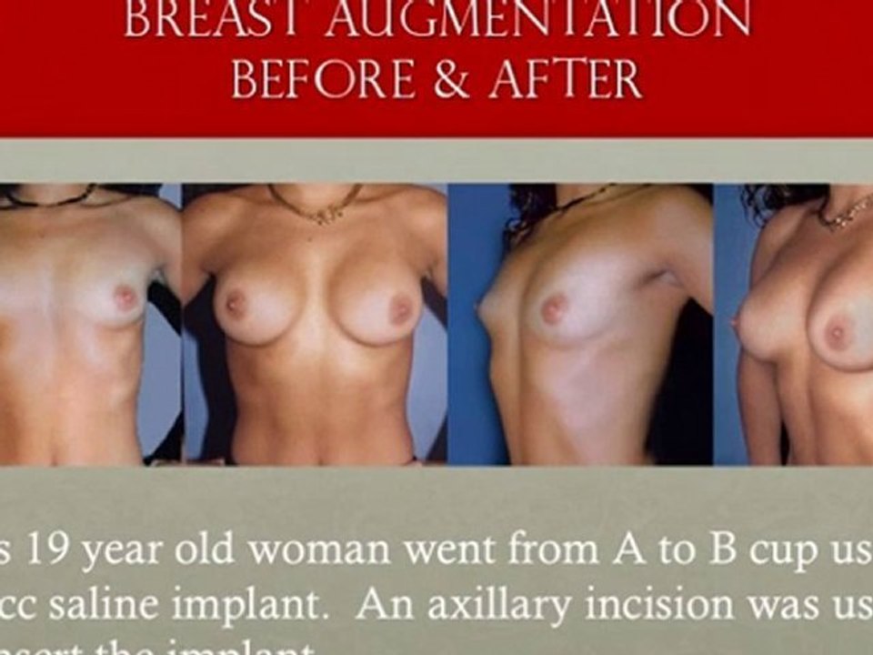 San Francisco Breast Enhancement Surgery-Cost