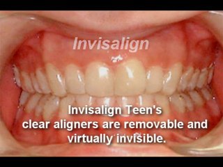 If you need braces then you need Rogers & Andrews Augusta G