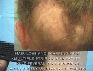 Worst Hair Transplant Result - Repair Using FUE & BHT