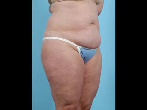 Ultrasonic Liposuction In Rocklin