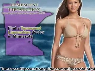 Tumescent Liposuction Minnesota