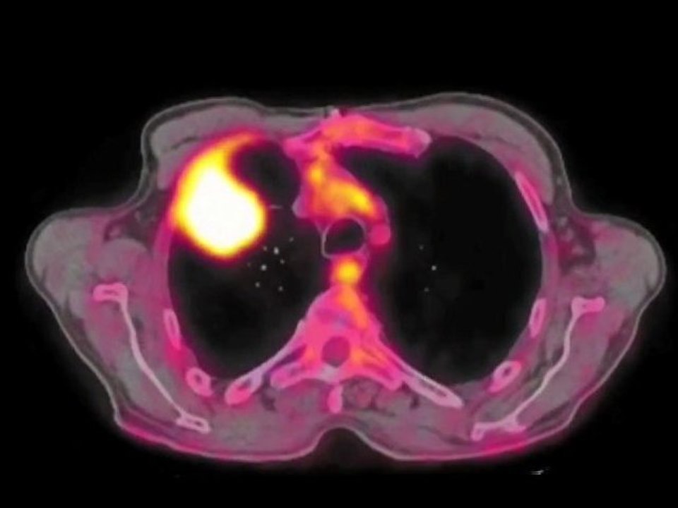 L'examen PET-CT