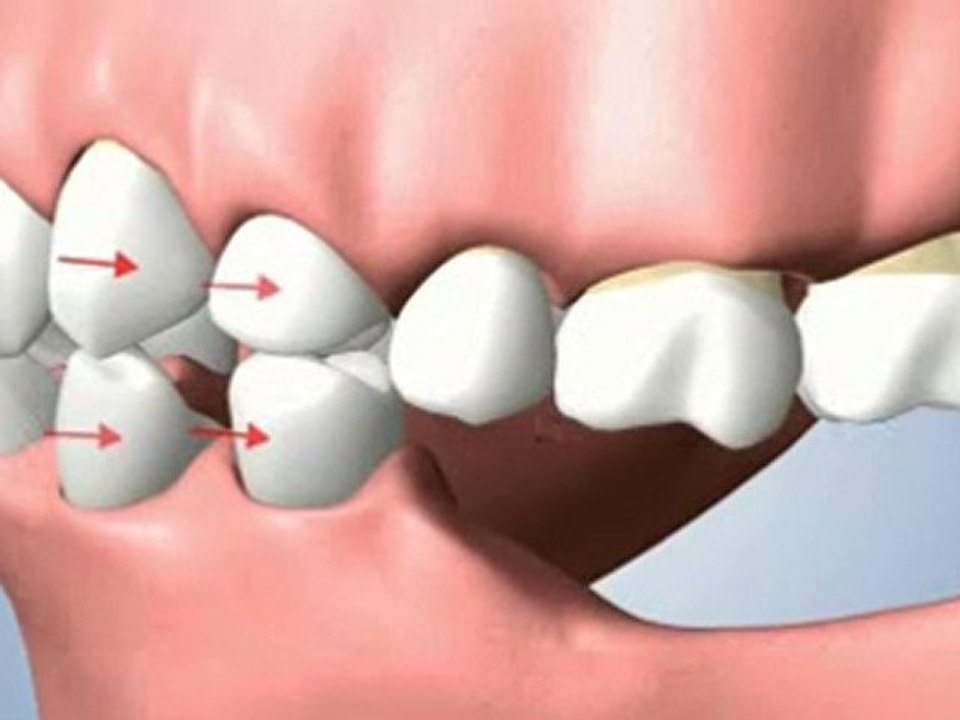 Houston Implant Dentist - Multiple Teeth Missing Problems