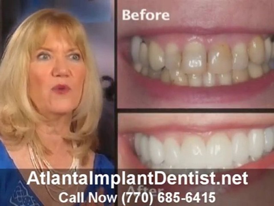 Atlanta Implant Dentist Services