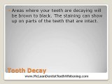 McLean VA Dentist Teeth Whitening – What causes tooth sta