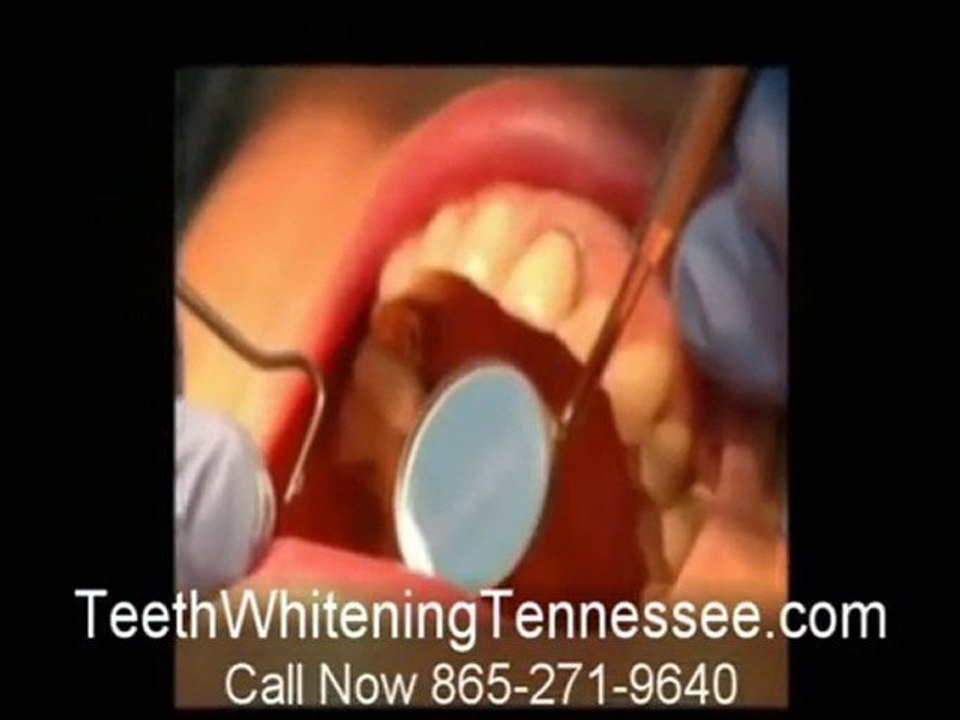 Teeth White Tennessee