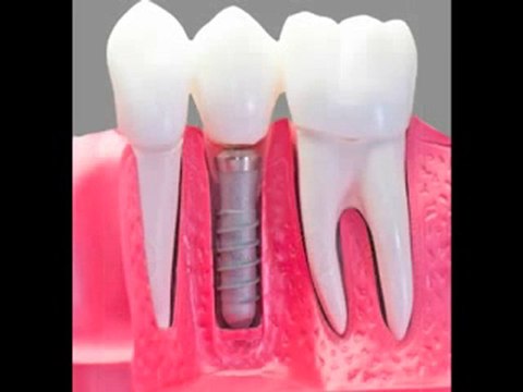 Dental Implants, Dentists, LaJolla Dentist San Diego