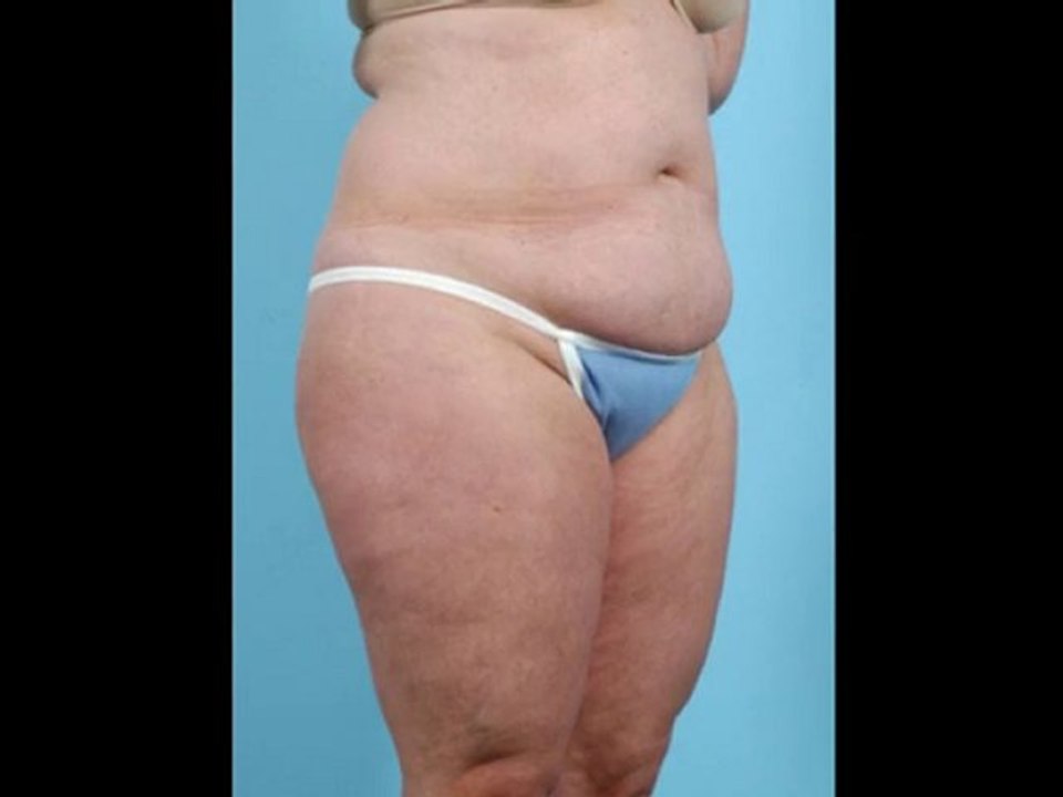 Roseville Liposuction Surgery