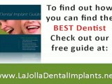 La Jolla San Diego, Dental Implants, Dentist, tooth replace