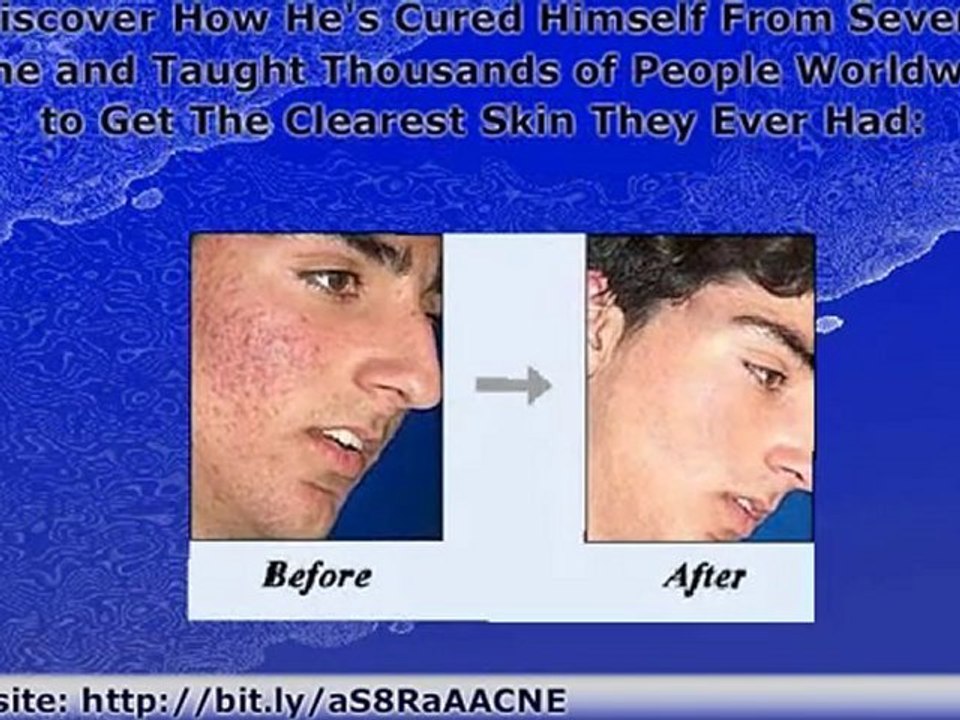 PERMANENTLY CURE YOUR ACNE WITH HOLISTIC TREATMENT!!!