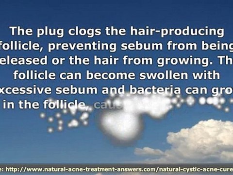 Natural Cystic Acne Cure - What Causes Cystic Acne and How t