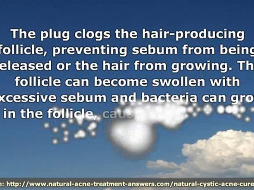 Natural Cystic Acne Cure - What Causes Cystic Acne and How t