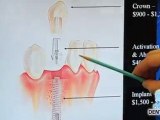 Denver Lowry dentist on dental implants to replace teeth.