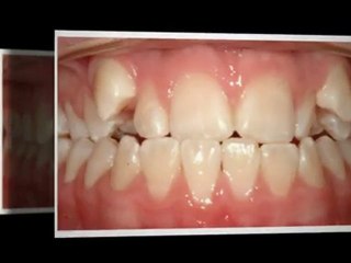 Westminster Orthodontist great new smiles