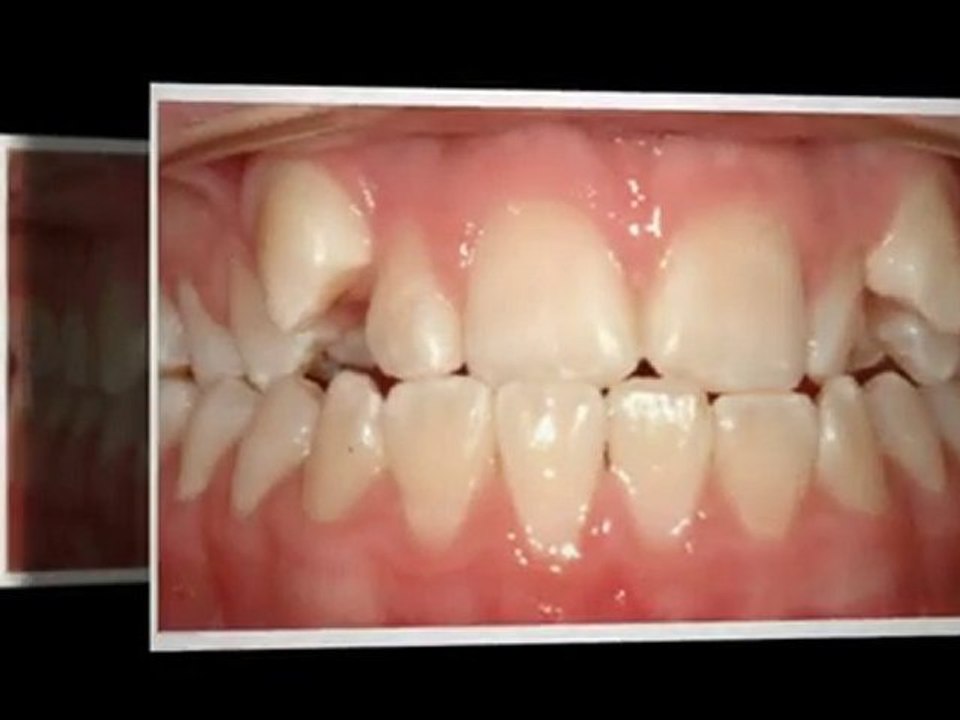 Westminster Orthodontist great new smiles