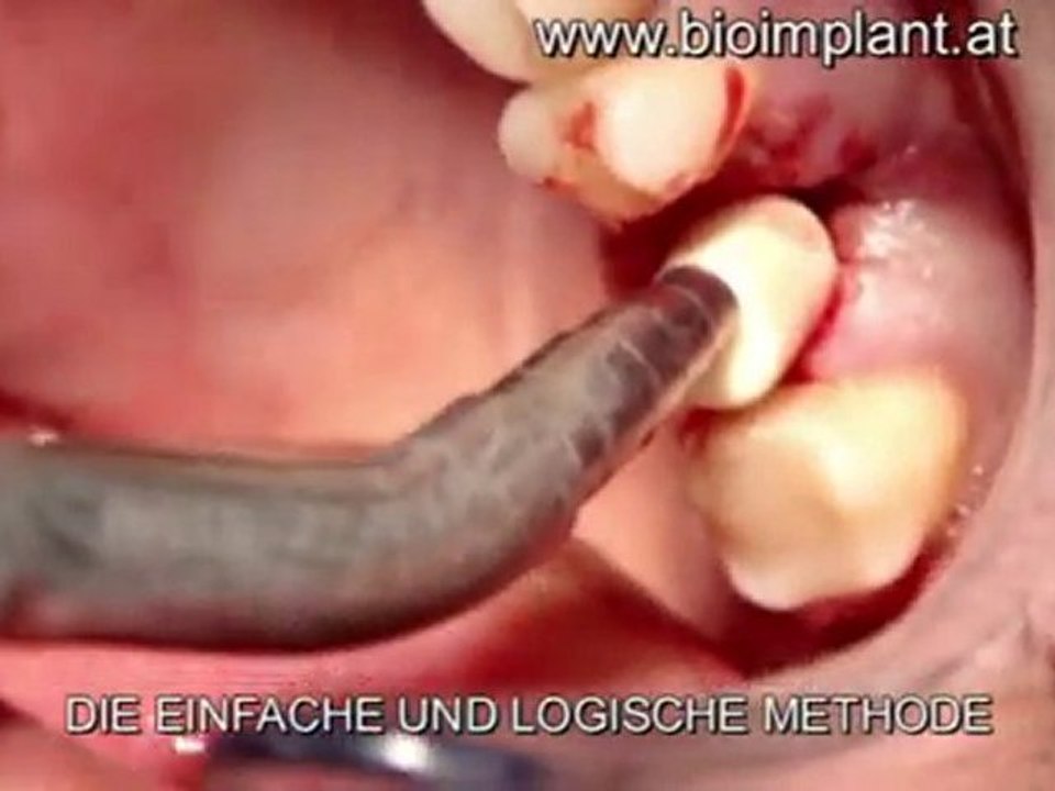 WELTNEUHEIT:   ANATOMISCHES ZIRKONOXID IMPLANTAT OHNE BOHREN