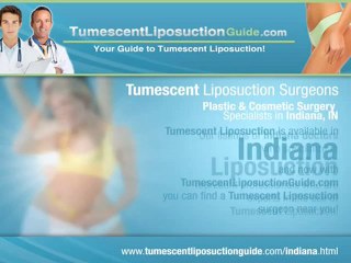 Tumescent Liposuction Indiana