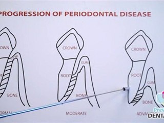 Denver Periodontist Neil Neugeboren explains Gum Disease