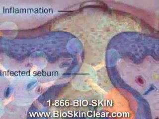 23-www.bioskinclear.com-Skin Care Acne Natural