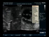 Baby Jr - 12 semanas e 3 dias, 5,6 cm