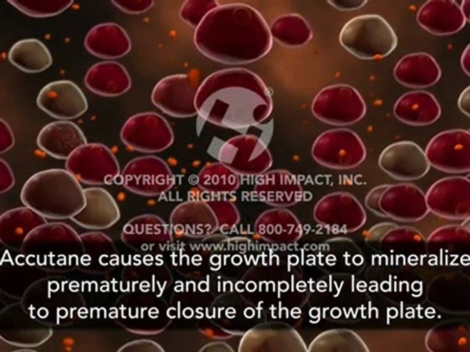 Effects of Accutane on Growth Plate
