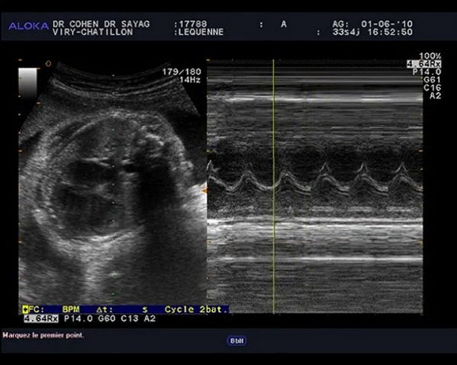 echo 1er juin battements du coeur