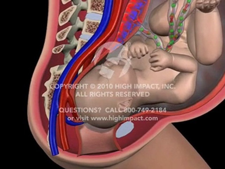 Amniotomy