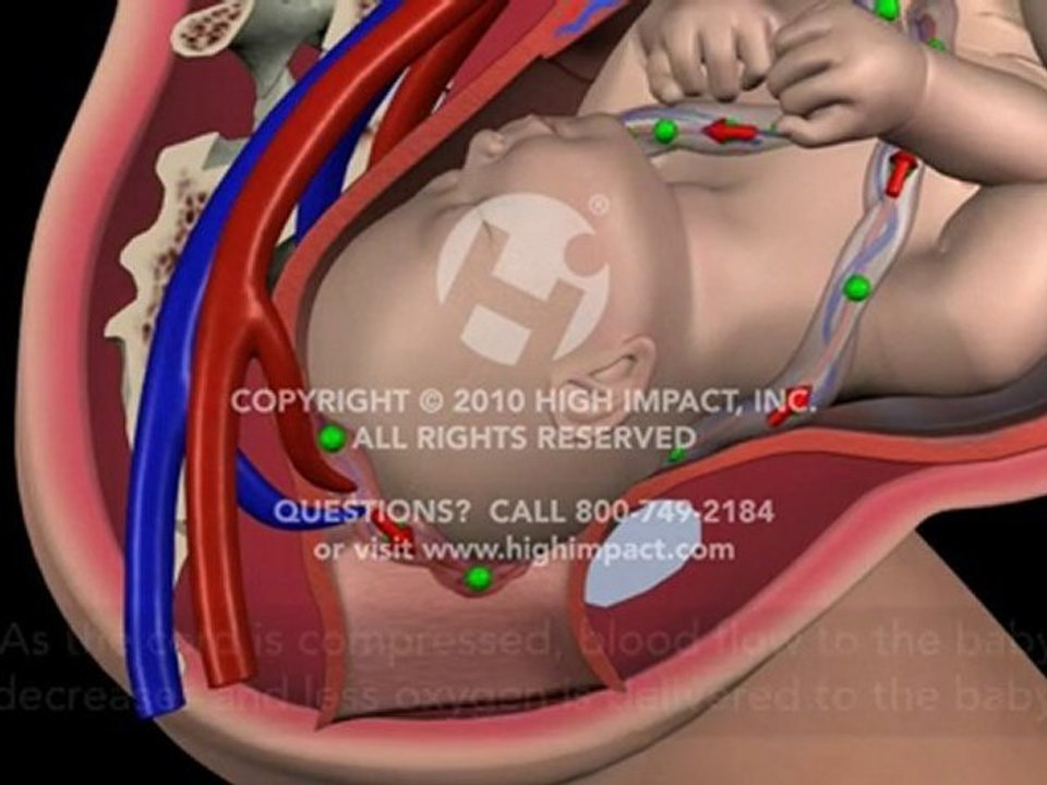 Cord Prolapse