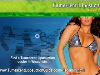 Tumescent Liposuction Wisconsin