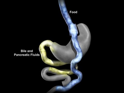 BARIATRIC Surgery, San Antonio Weight Loss