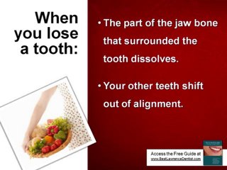 Dental Implants From Your Lawrence KS Dentist