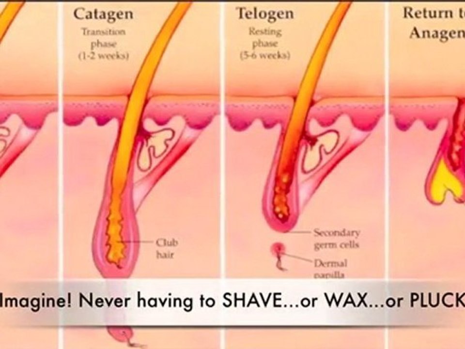 Does Permanent Unwanted Body Hair Removal Hurt / Work? Is L