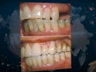 Discover the Denture Options Offered by Oxford Dentists 🦷