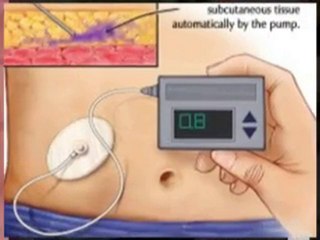 Hypoglycemia Diet. Diabetes. Hypoglycemic tretment. Low