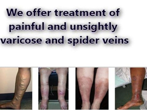 Vein Removal Minneapolis | 952-934-3296