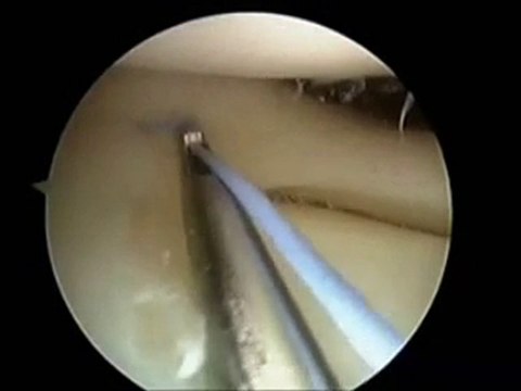 Forum Ege Tıp - Ön Çapraz Bağ Ameliyatı