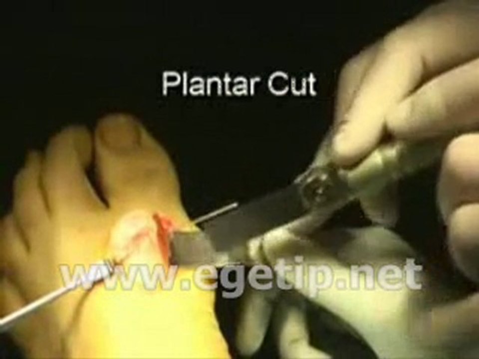 Forum Ege Tıp - Bunyonektomi 1. Kısım