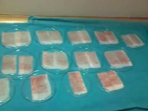 SAÇ EKİMİNDE REKOR! 5500GRAFTS (15 000 SAÇ TELİ) SAÇ EKİMİ