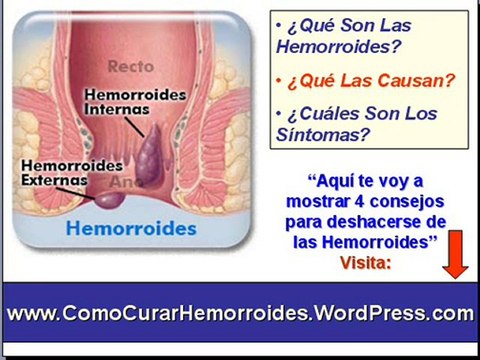 Como curar las hemorroides - Como eliminar las hemorroides