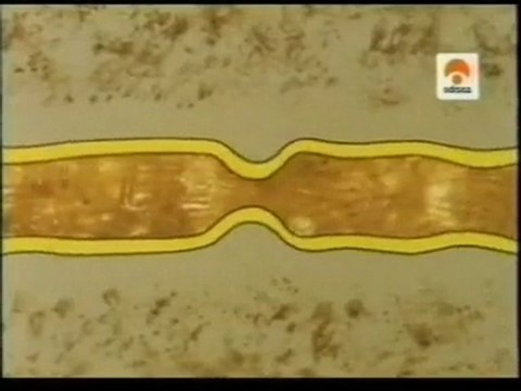 Fibra y transito intestinal: Cancer de colon-diverticulitis