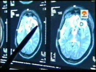 Hipotalamo: Interruptor del apetito (Sven: Tumor cerebral)