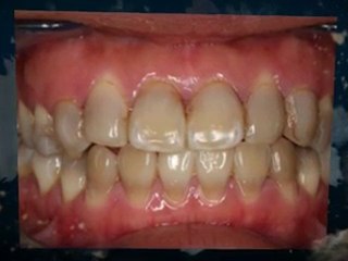 Teeth Whitening in Hatfield, Hertfordshire, World Cup Offer